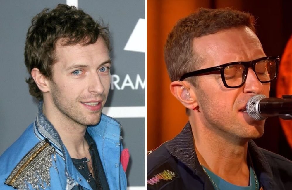 Chris Martin’s Hair Transplant: Are the Rumours True?