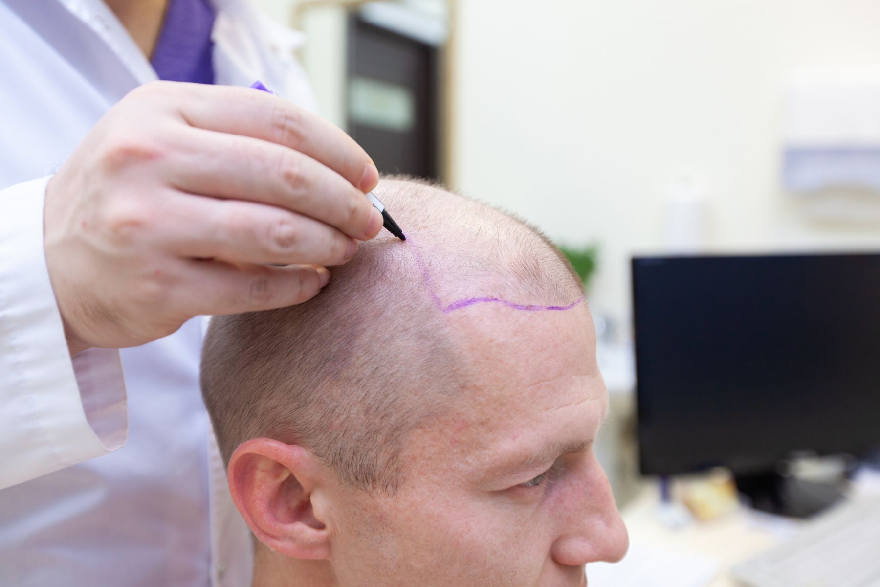 Hair transplant preparation