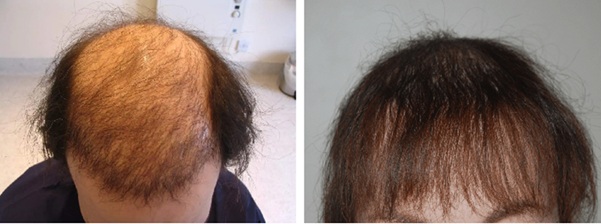 Patient before and after 5000 grafts hair transplants