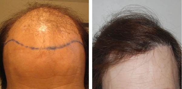 Wimpole patient before and 18 months after hair transplant