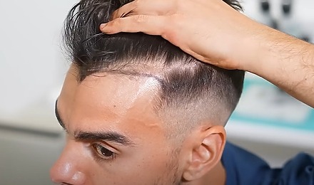 5000 Graft Hair Transplants