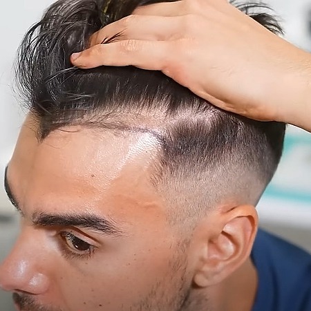 5000 graft hair transplants