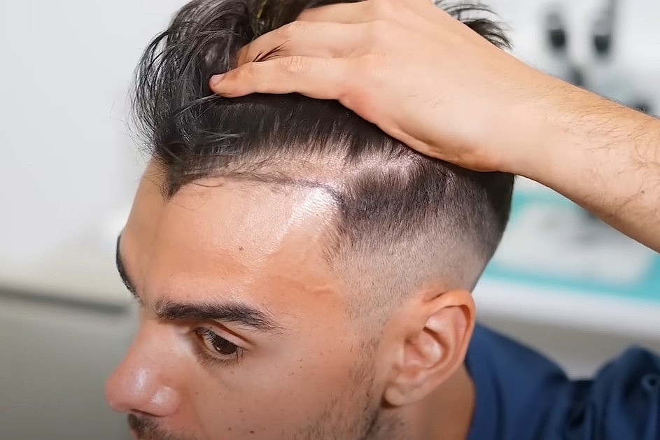 5000 graft hair transplants