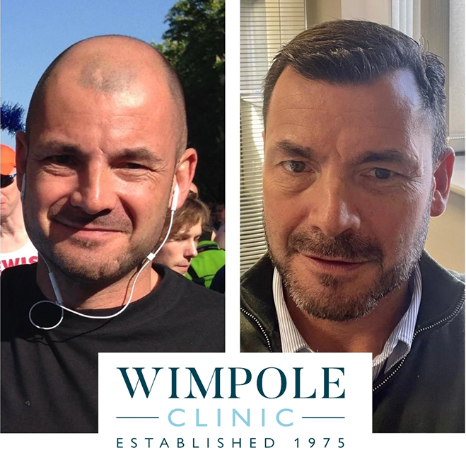 FUT Hair Transplant, Wimpole Clinic