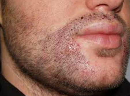 1 week after FUE beard transplant