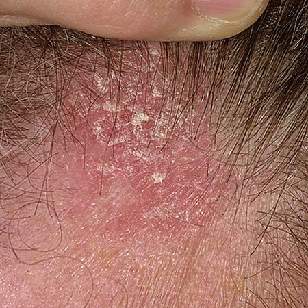 Atopic dermatitis