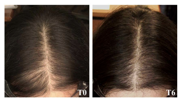 how to regrow hair naturally