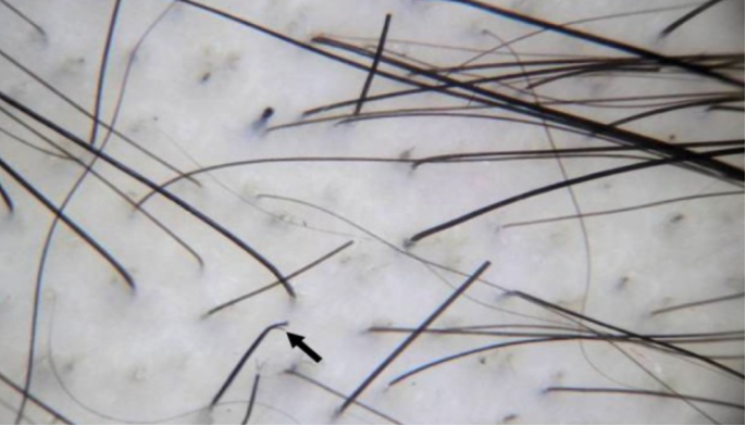 Broken hairs and split end in trichotillomania