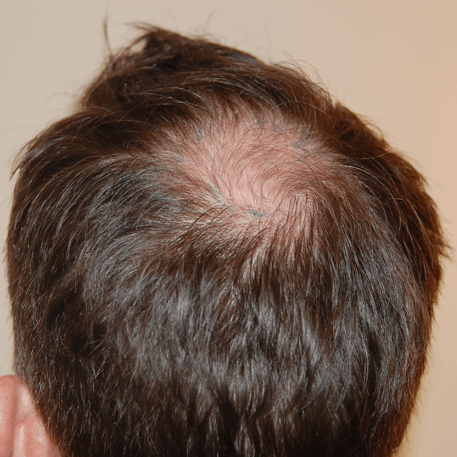 Crown Hair Transplant, Wimpole Clinic