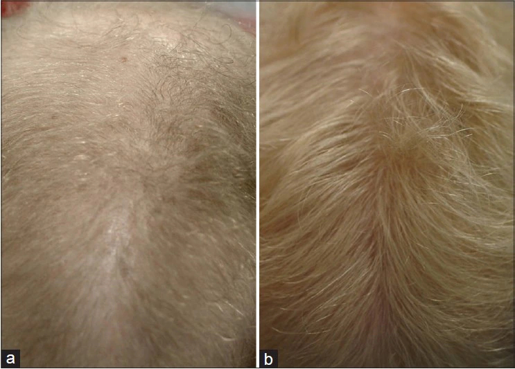 DHT blocker for women's hair loss