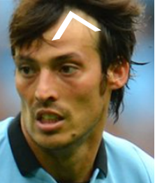 David Silva's receding hairline