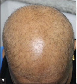 Diffuse alopecia areata