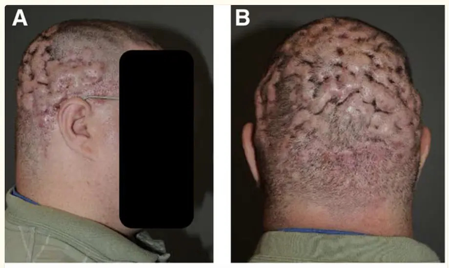 Dissecting cellulitis
