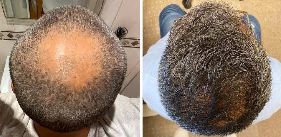 Before and 15 months after FUE hair transplant to treat male pattern hair loss
