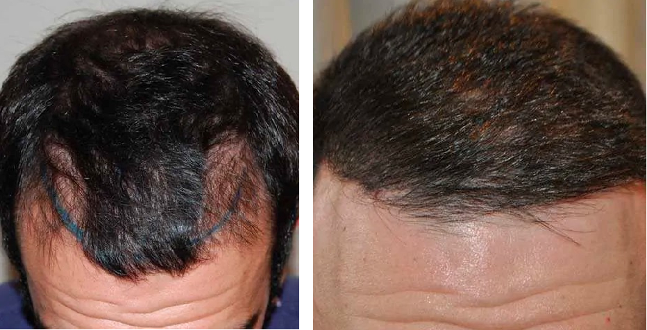 Before and 8 months after FUE hair transplant surgery to treat male pattern baldness