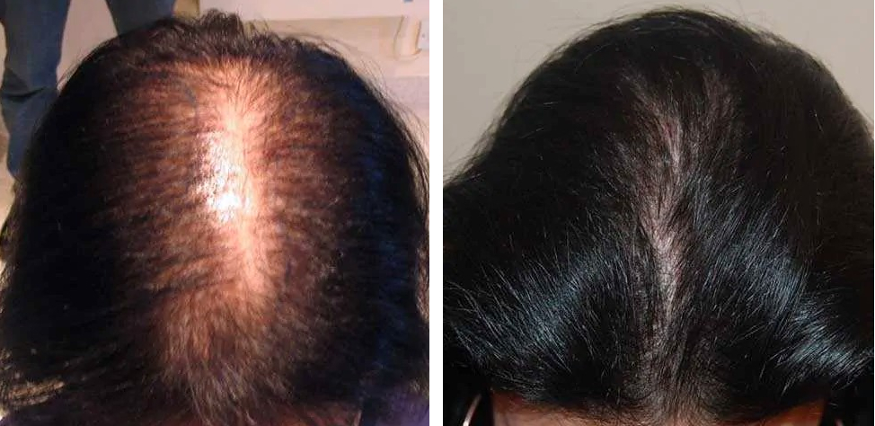 Before and 12 months after FUT hair transplant to treat female pattern hair loss