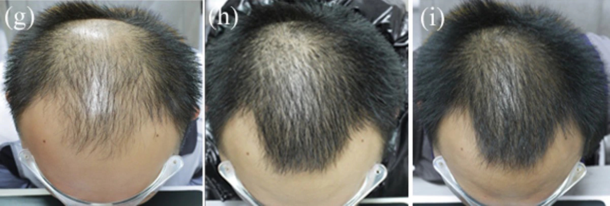 Finasteride for hairline before and after taking oral Finasteride combined with topical Minoxidil