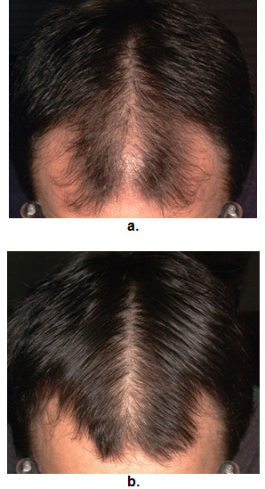 Finasteride for hairline: before and after