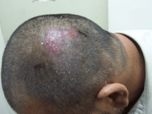 Folliculitis After Hair Transplant