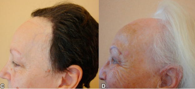 Frontal Fibrosing Alopecia