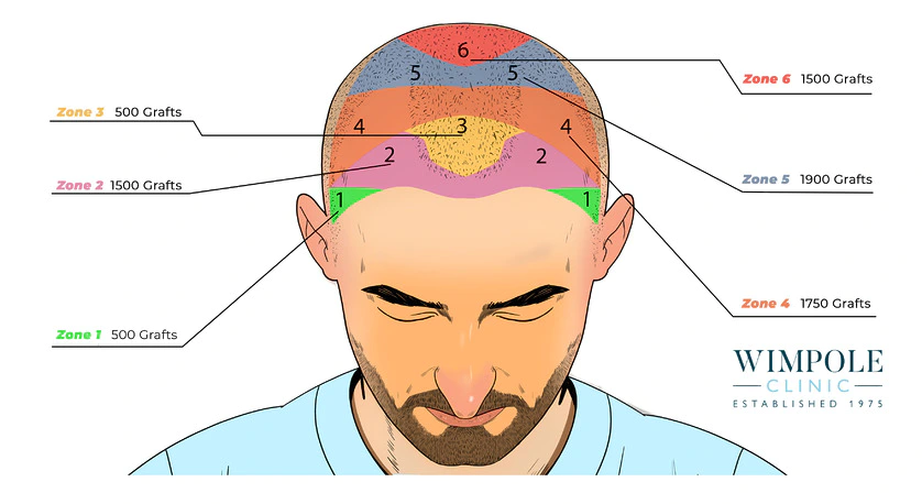 Graphic image of the amount of hair grafts required for a hair transplant