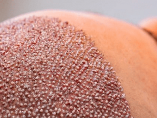 Hair Transplant Close Up: Photos, Videos & Results