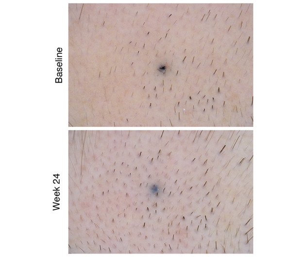 Hair density at baseline and after 24 weeks of Finasteride treatment