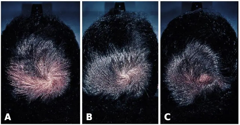 Finasteride 1mg results after 12 and 24 months in male pattern hair loss patient