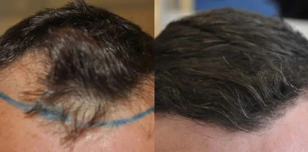 how to fix hairline