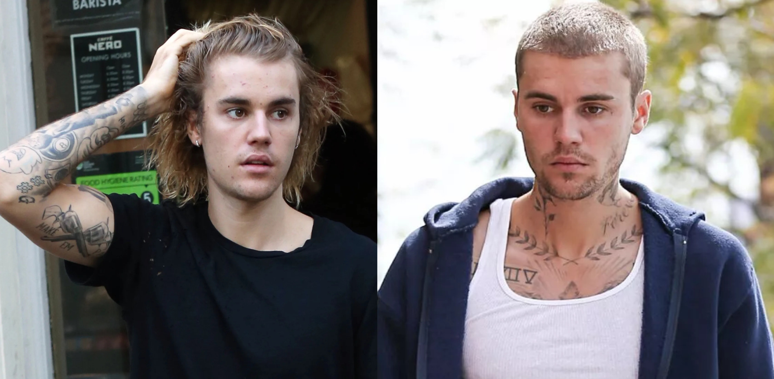 Justin Bieber Hair Loss: Everything You Need To Know