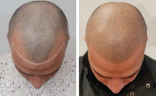 how to get a straight hairline