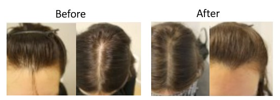Before and after Minoxidil results after 1 year for female pattern baldness 
