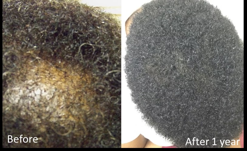 Minoxidil Results After 1 Year for alopecia areata