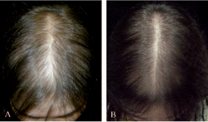 before and after results of using 5% liquid Minoxidil on a female patient with androgenetic alopecia