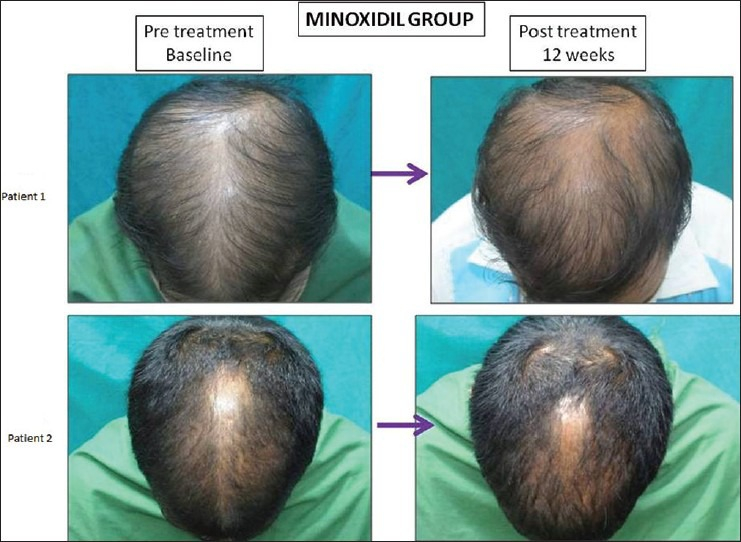 Man after 3 months of Minoxidil use