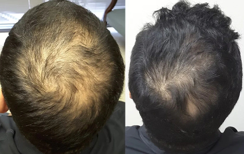 Man after 1 year of Minoxidil use