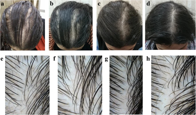 Female patient after 6 months of minoxidil