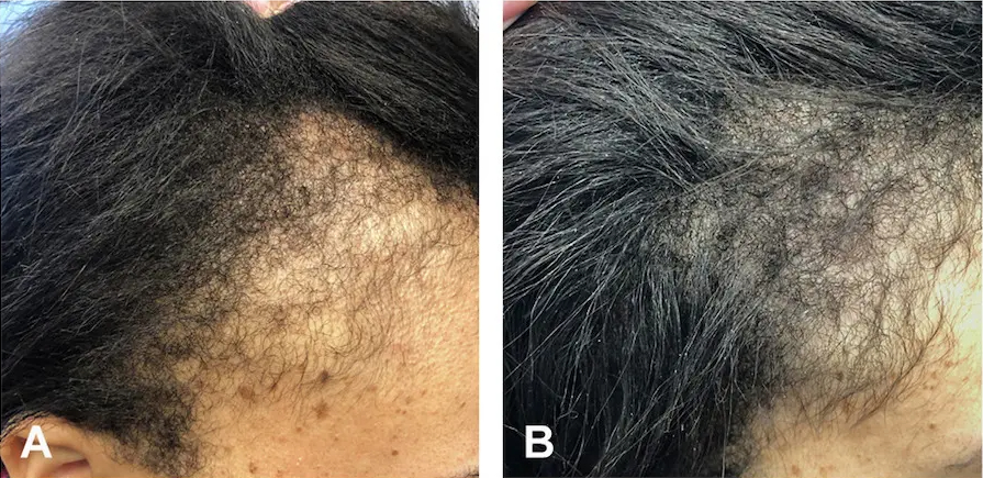 Minoxidil results after 1 year for traction alopecia