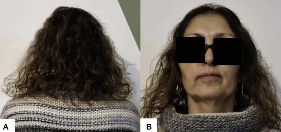 Minoxidil hair regrowth results after 1 year for chemotherapy-induced hair loss