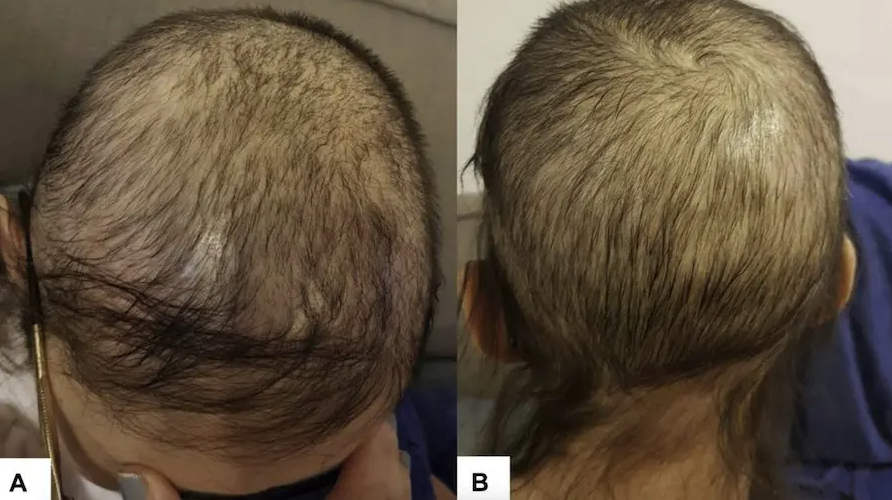 Topical Minoxidil for treatment of chemotherapy-related hair loss