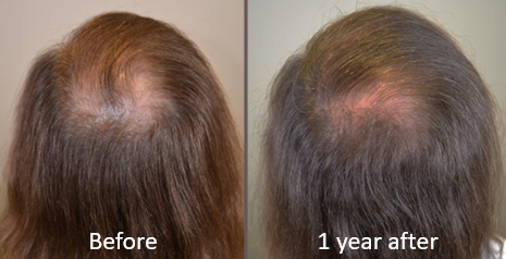 Minoxidil results for telogen effluvium hair loss