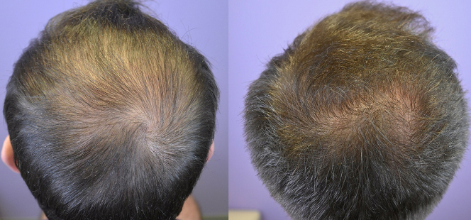 Before and after results of using oral Minoxidil for 12 months