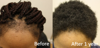 2% topical Minoxidil results after 1 year for traction alopecia hairline