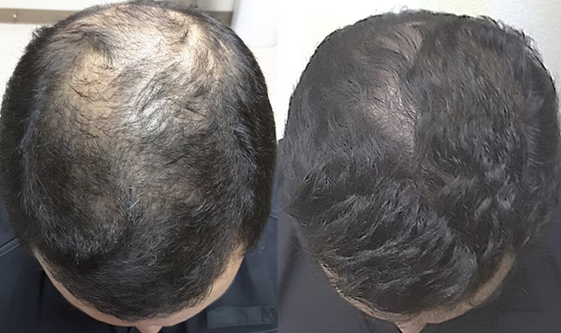 5% Minoxidil results after 1 year for male pattern hair loss