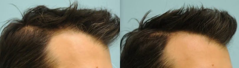 Minoxidil results after 1 year for male pattern baldness temple hair loss