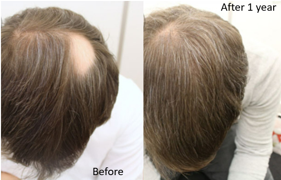 Before and after results of Minoxidil for treatment of alopecia areata