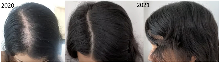 Minoxidil results after 1 year for female pattern baldness 