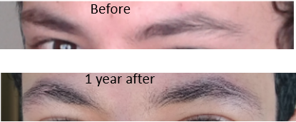 Before and after taking Minoxidil for eyebrow hair loss