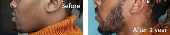 Before and after Minoxidil treatment for beard hair growth