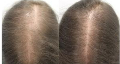 Oral Minoxidil results after 1 year for female pattern baldness 